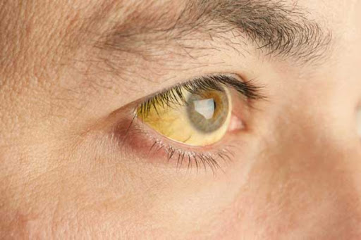 درمان زردی چشم