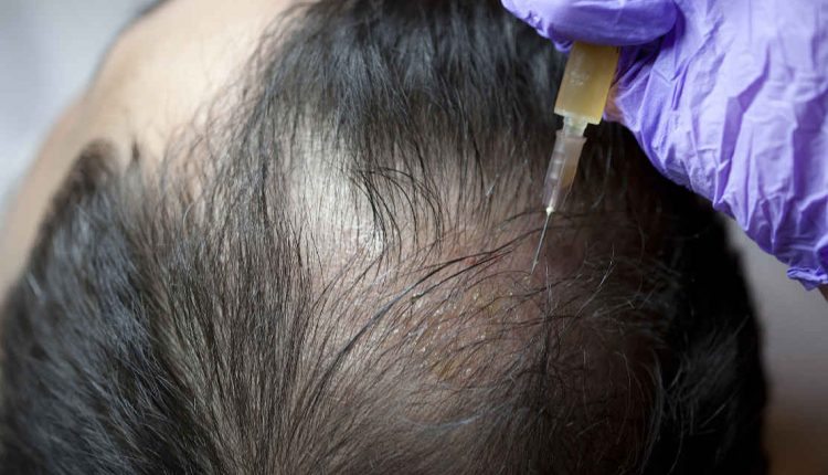 کاشت مو با روش سلول های بنیادی