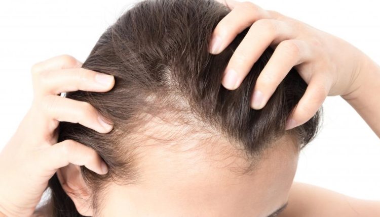 درمان آلوپسی یا ریزش مو