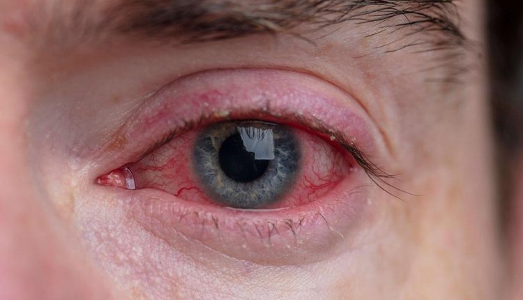 التهاب ملتحمه چشم